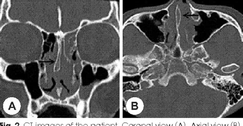 Perpendicular Plate Of Ethmoid Bone Ct Slidesharetrick