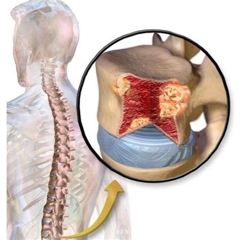 Mieloma M Ltiple Qu Es S Ntomas Y Tratamiento Top Doctors