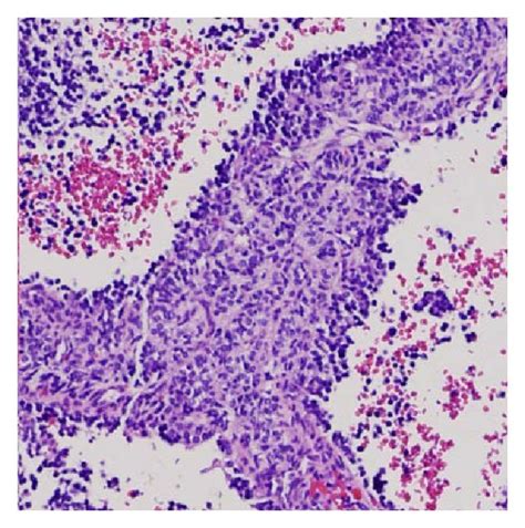 Histologic Features Of Tumor In The Left Inguinal Lymph Node A The Download Scientific