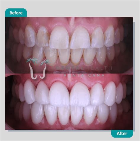 Types of Veneers