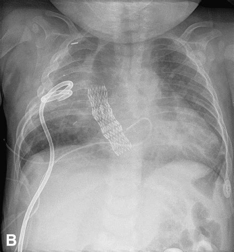 Esophageal Stenting In Children Indications Application