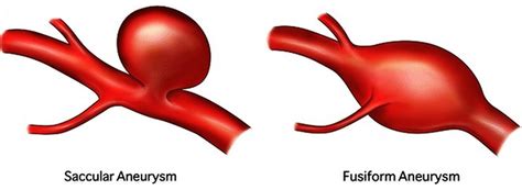 Brain Aneurysm Causes Symptoms Warning Signs Treatment