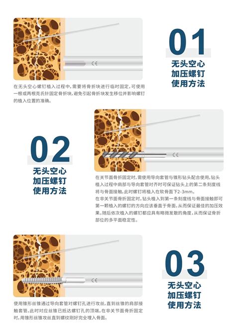 再生型无头加压螺钉 深圳市立心科学有限公司