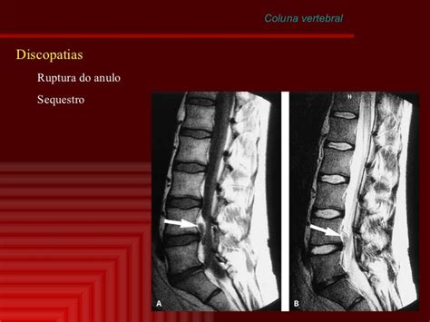 Coluna Vertebral