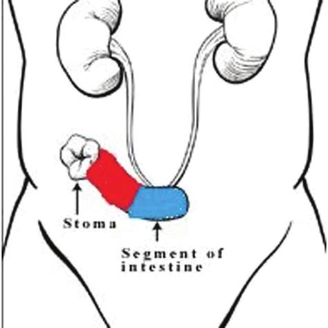 Ileo-ileal conduit on conduit (Red is new conduit and blue is previous ...