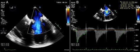 Follow Up Two Dimensional Transesophageal Echocardiography Showing Download Scientific Diagram