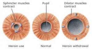 HealthoolA comparison image showing a normal sized pupil, constricted ...