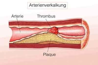 Arteriosklerose Ursachen Symptome Behandlung Medlexi De