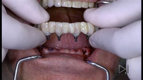 Dental Implants Procedure Video Youtube