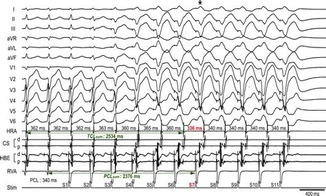 Analyses Of The Mode Of Termination During Diagnostic Ventricular Pacing To Differentiate The