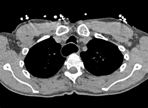 Severe Esophagitis With Pneumomediastinum Chest Case Studies Ctisus