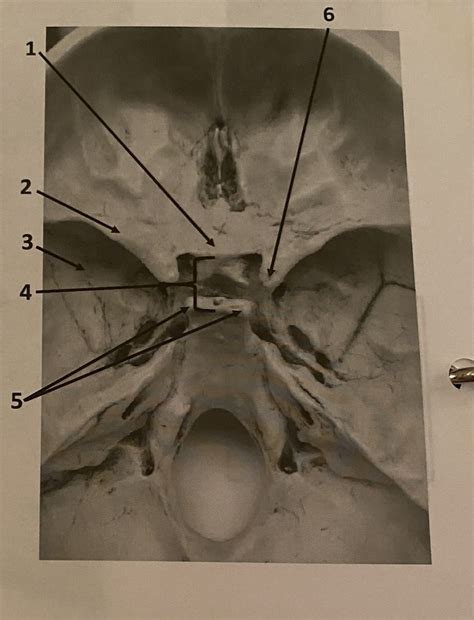 Sphenoid Bone Diagram Quizlet