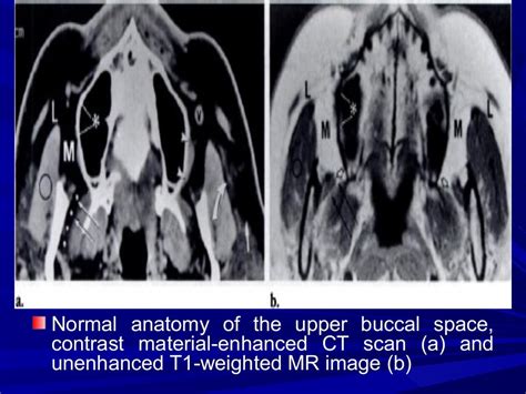 Imaging of buccal space