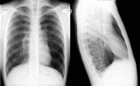 Basic Chest X Ray Interpretation Tips And Pointers To See It All