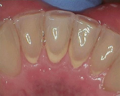 Calculus Teeth Before And After Bingerfinance