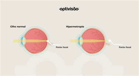 Hipermetropia O Que é Causas E Tratamentos Optivisão