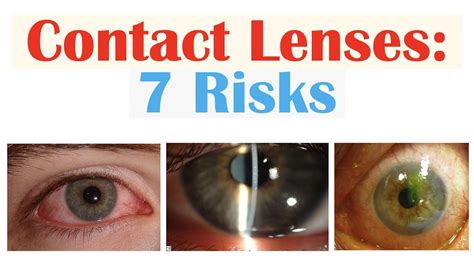 7 Risks Of Contact Lens Use Eye Infections Disease And Complications