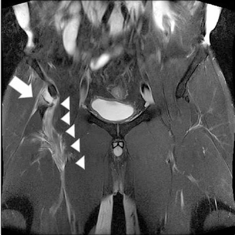 PDF Treatment Of Avulsion Fracture Of Proximal Rectus Femoris With