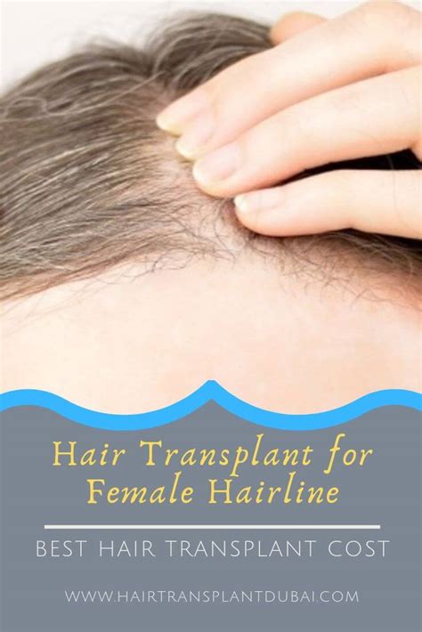 Why Doctors Recommend Hair Transplants For Female Hairline Hair