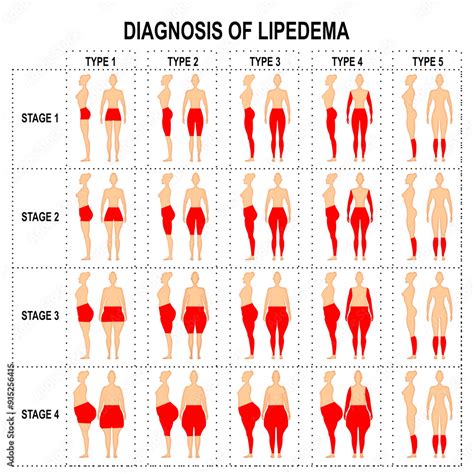 Types and Stages of Lipedema Stock Illustration | Adobe Stock