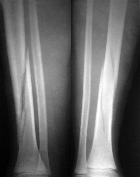 Xray Pictures Of Fractured Tibia Bone And Spine