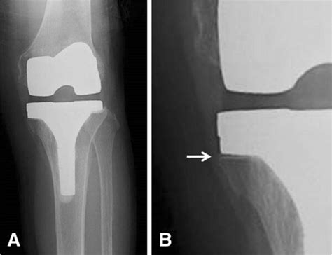 One Year Postoperative Anteroposterior Radiographs Revealing The