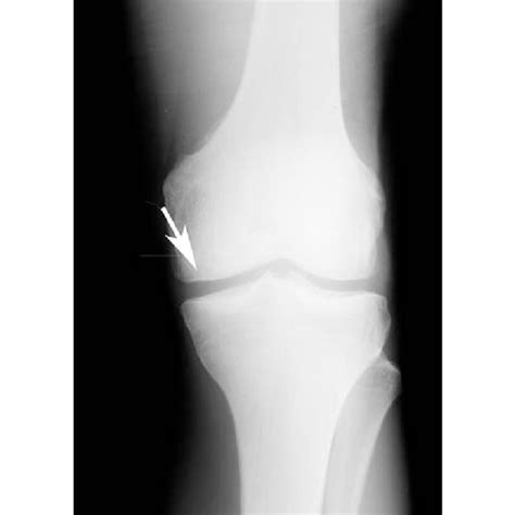 A Mr Image Of The Second Twins Knee Shows The Area Of The Lesion