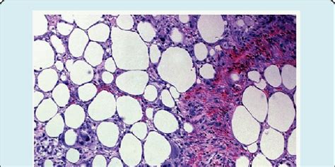 Aseptic necrosis of bone with necrotic adipose tissue, calcified,... | Download Scientific Diagram