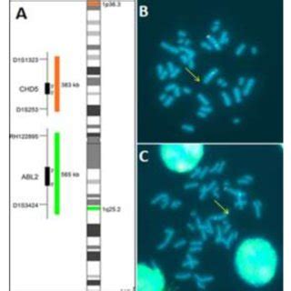 Pdf P Deletion Syndrome First Case Report In Morocco Detected By