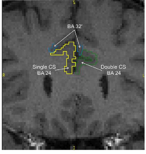 MRI image. ACC is displayed with a single (yellow) and double (green ...