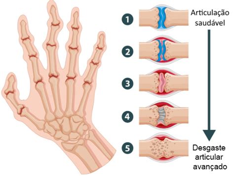 Artrite E Artrose Voc Sabe A Diferen A Dr Vinicius Sabag