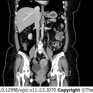 Computed Tomography Of Abdomen Pelvis Coronal Cut Showing Signs Of