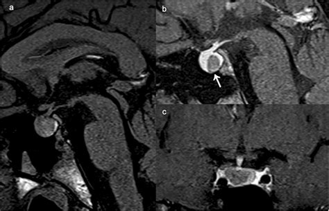 Rathke Cleft Cyst On Sagittal T1 Wi Pre Contrast A Sagittal B And