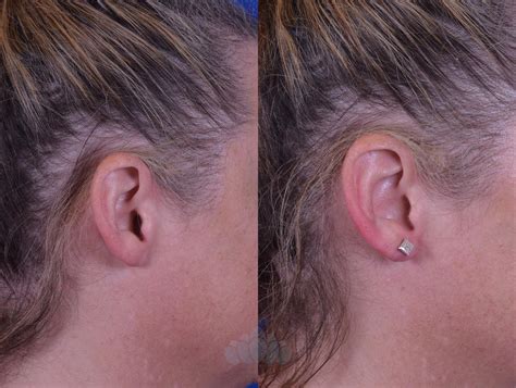 Earlobe Repair Before And After Pictures Case 83 Charlotte Nc