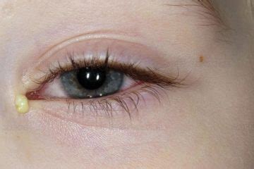 Bacterial Conjunctivitis Causes Symptoms Signals And Treatment