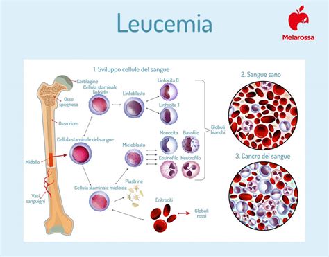 Leucemia Che Cos Sintomi Cause Diagnosi E Cure