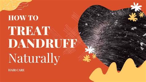 12 Easy Ways How To Treat Dandruff Naturally Say Goodbye To Flakes 2024