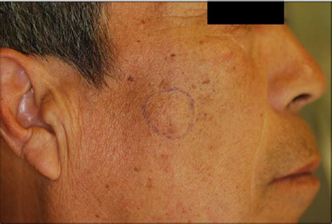 Figure 1 From A Case Of Acinic Cell Carcinoma Involving Skin Semantic