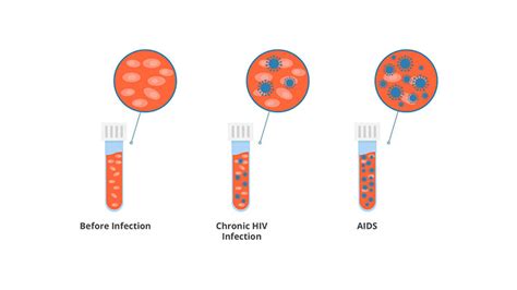 HIV vs AIDS | Priority STD Testing