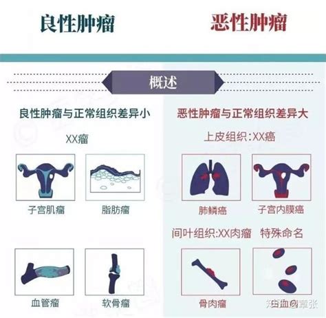 教你辨别：良性肿瘤与恶性肿瘤 知乎