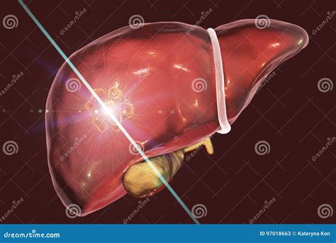 Liver Cancer Treatment With Laser Stock Illustration Illustration Of Laser Closeup 97018663