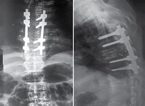 Immediate Postoperative X Ray Of Dorsal Spine Aplateral Views Showing Download Scientific