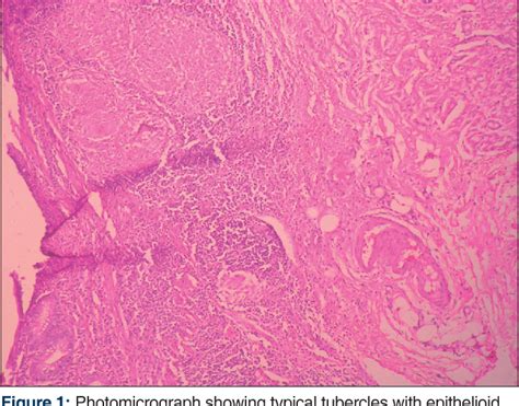 Figure From A Case Of Staphylococcus Lugdunensis Related Pyomyoma