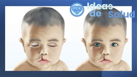 Qu Es El Labio Leporino Y Cu Les Son Las Causas Ideas De Salud