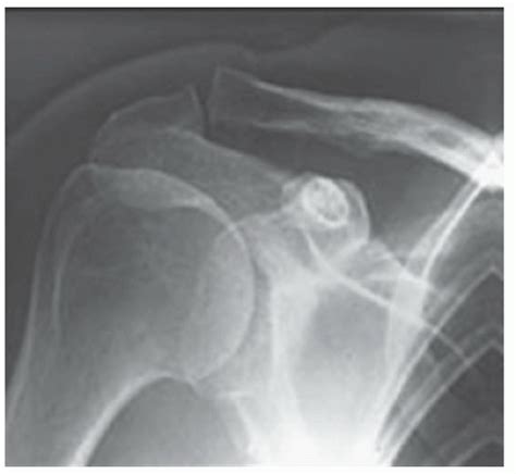 Acromioclavicular Joint Arthritis | Musculoskeletal Key