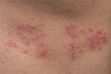 Shingles Rash Stock Photos, Pictures & Royalty-Free Images - iStock