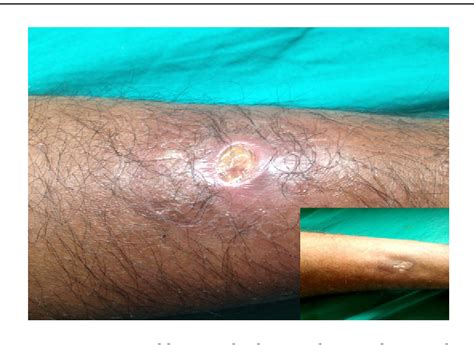 Figure 1 From Borderline Tuberculoid Leprosy Lupus Vulgaris And