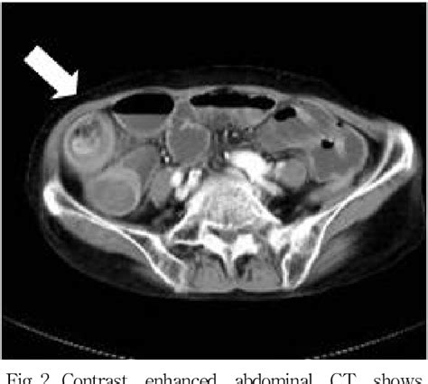 Figure 2 From A Case Of Jejunal Diverticulitis With Perforation Combined With Intussusception