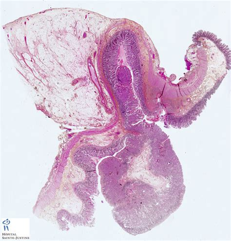 Meckel diverticulum - Humpath.com - Human pathology