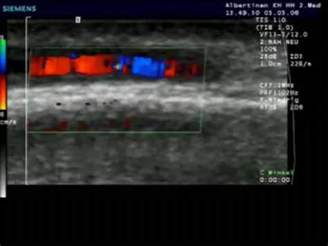 Arteriitis Temporalis DocCheck